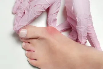 Aesthetic foot surgery - Bunion