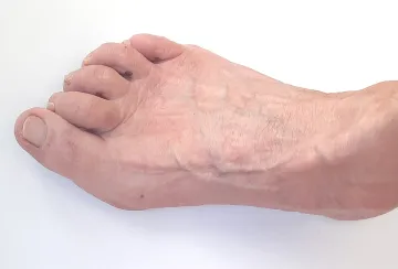 Aesthetic Foot Surgery - Hammer Toes