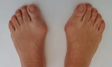 Minimally invasive correction of bunions on the right and left feet