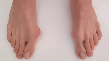 Bunion