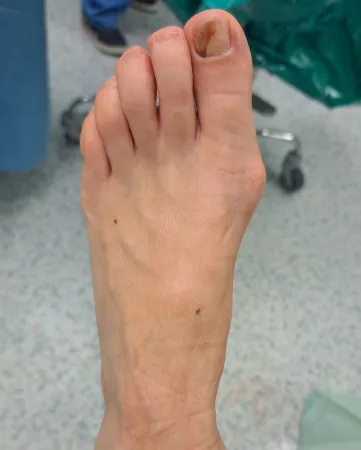 Minimally invasive bunion correction