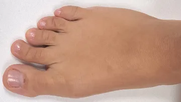 Minimally invasive correction of 2nd toe deformity
