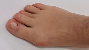 Preoperative photo of bunion