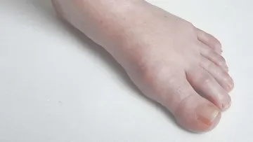 Big Toe Artritis