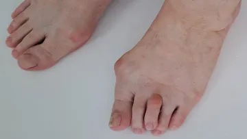 Bunion on both feet and deformity of the toes on the left foot