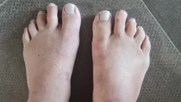 Mini-invasive correction of bunion on both feet – November 2024 and 2025