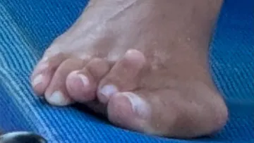 Correction of deformity of the toes of the right foot