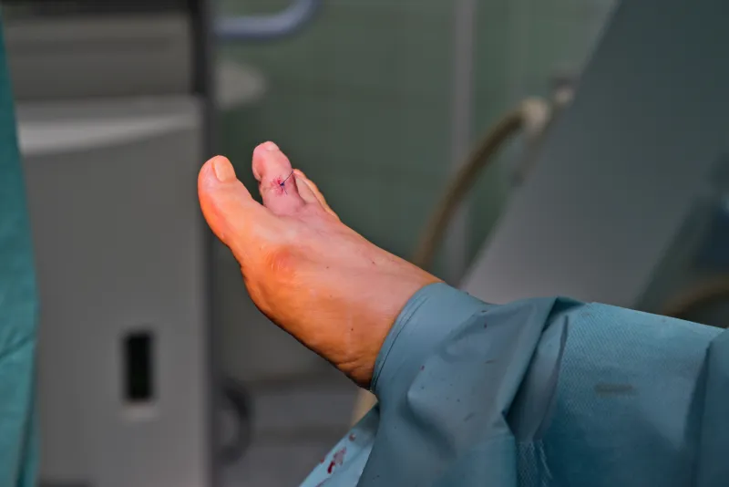 Aesthetic foot surgery