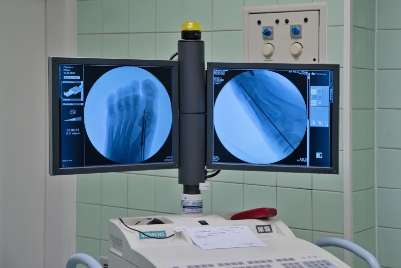 Aesthetic foot surgery