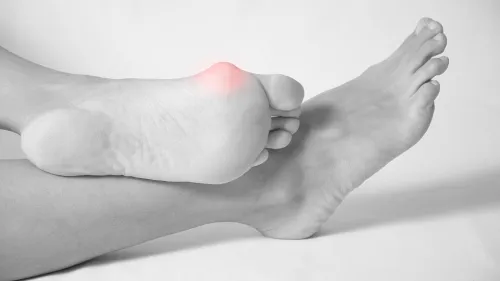 Aesthetic foot surgery - bunion