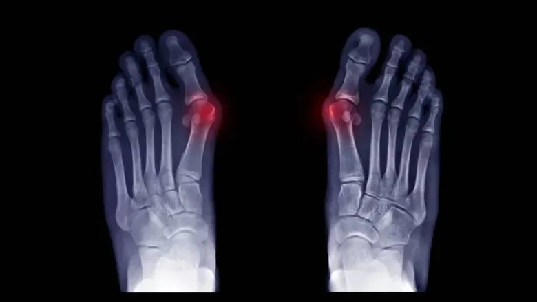 X-ray of a bunion