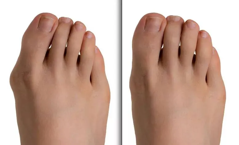 Bunion before and after surgery
