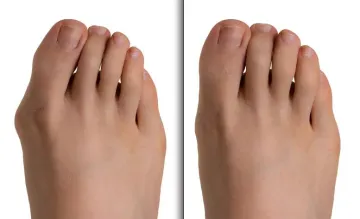 Bunion before and after surgery