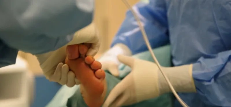 Aesthetic foot surgery - Surgery