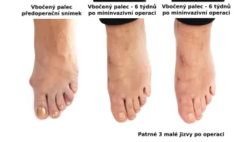 Bunion before and after surgery