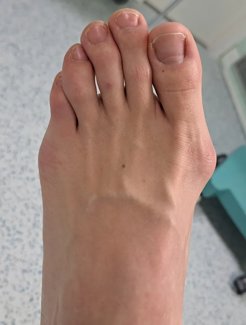 Mini-invasive bunion correction - before surgery