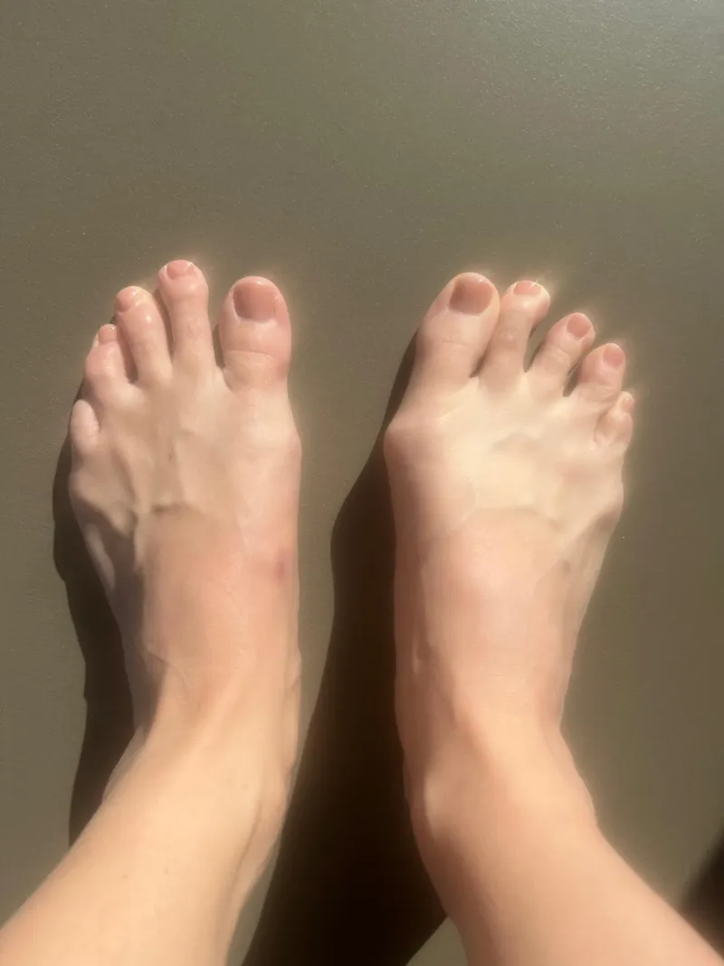 Mini-invasive bunion correction - after surgery