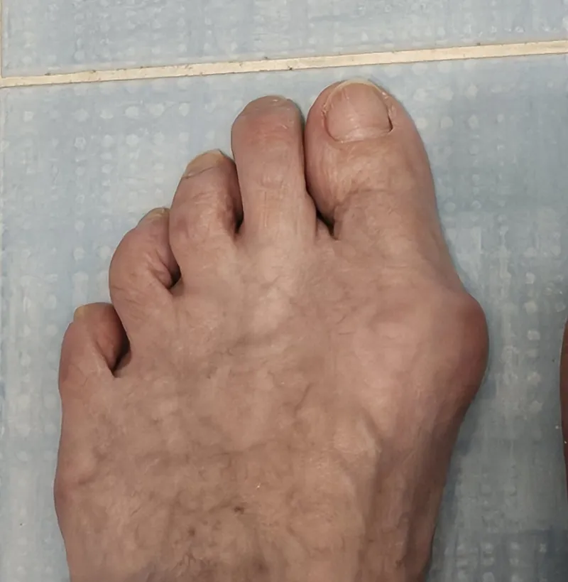 Mini-invasive bunion correction - before surgery