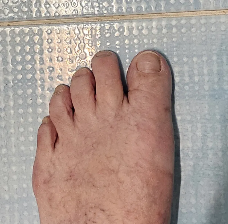 Mini-invasive bunion correction - after surgery