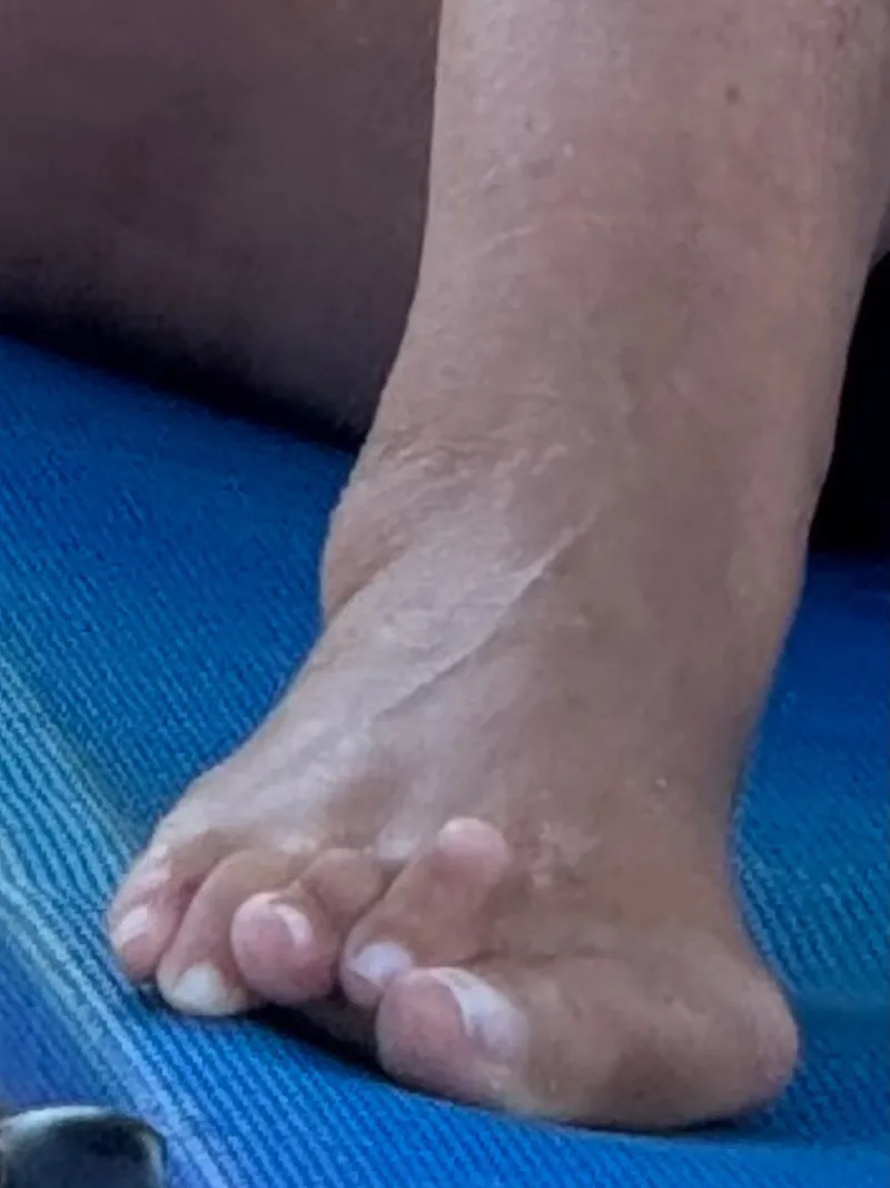 Finger deformity before surgery