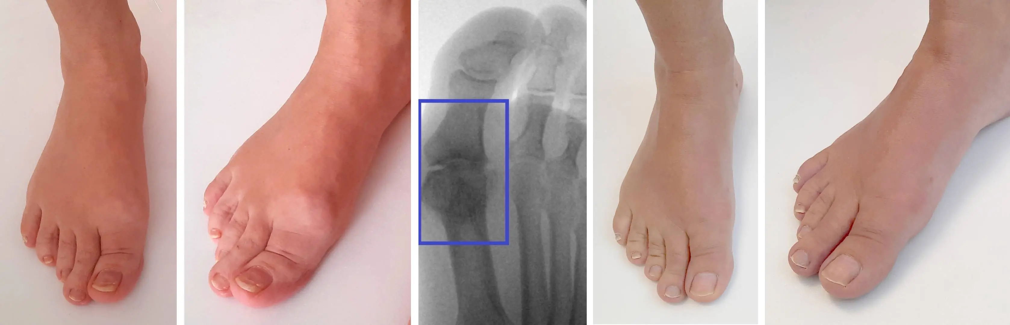 Big Toe Artritis