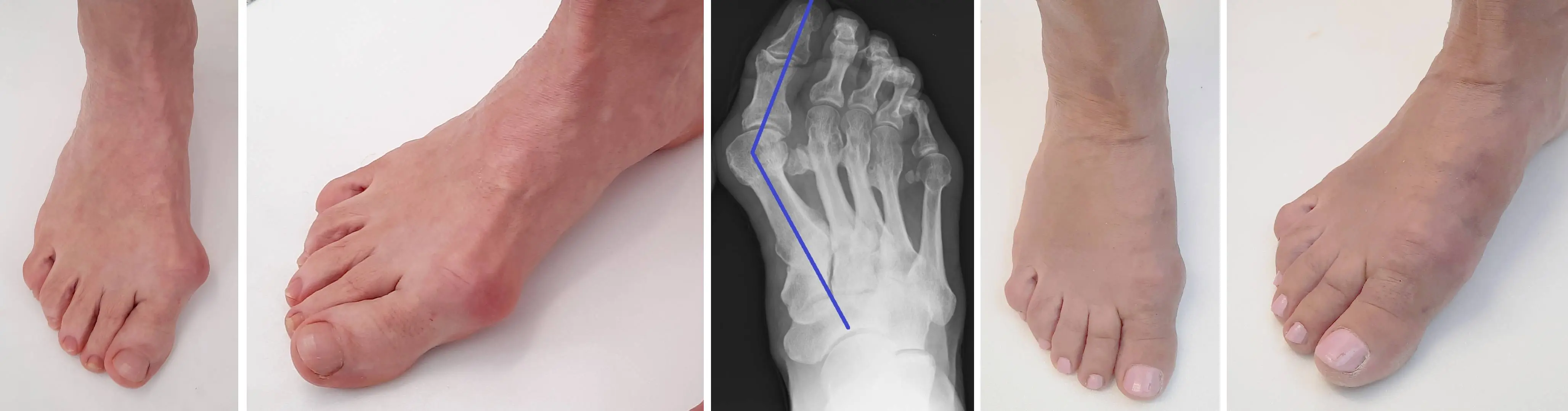 Bunion