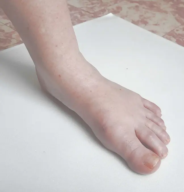 Big Toe Arthritis After Surgery