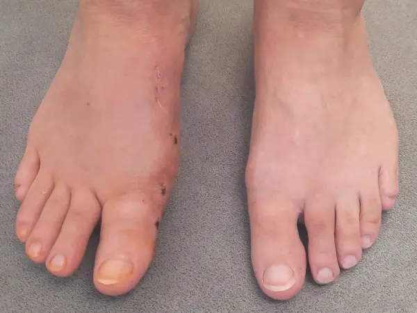 Bunion - Two Weeks After Surgery