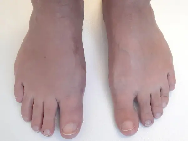 Bunion - Six weeks after surgery A