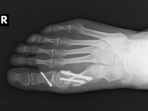 Bunion - X-ray six weeks after surgery