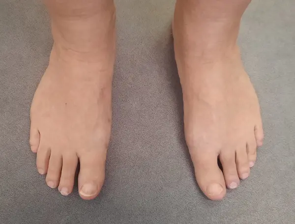 Bunion - 5 months after surgery A