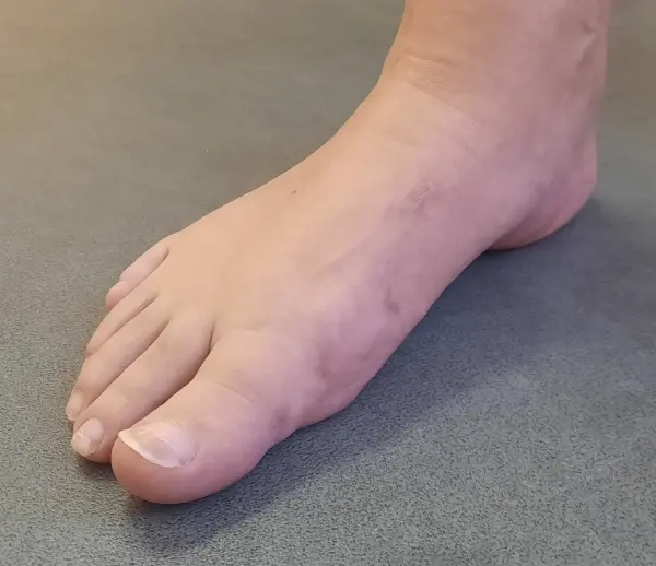 Bunion - 5 months after surgery B
