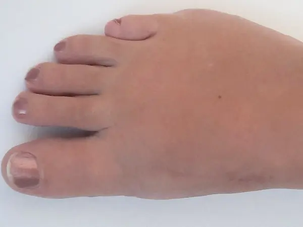 Bunion - Eight weeks after surgery A