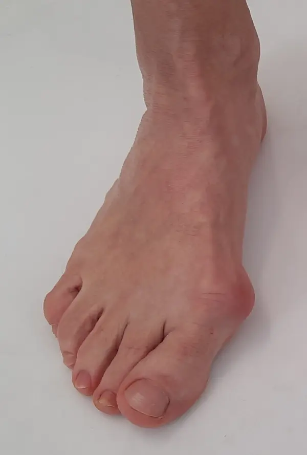Before Bunion Surgery
