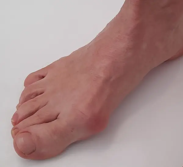 Before Bunion Surgery