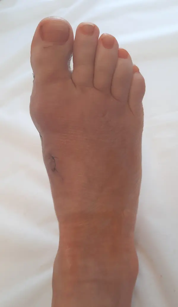 The First Week After Bunion Surgery