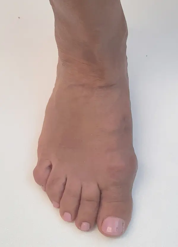 3 months after bunion surgery