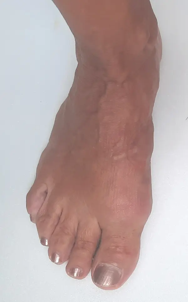 5 months after bunion surgery