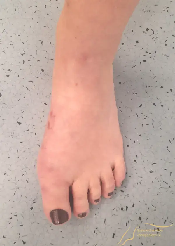 Big toe position corrected to correct position