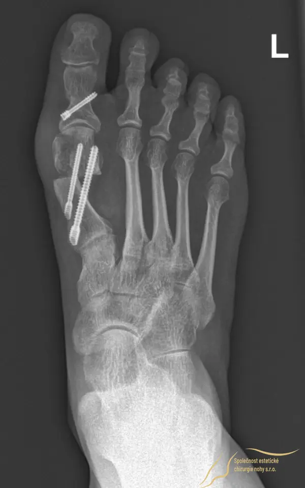 The bones of the big toe are secured in their new position with 3 screws