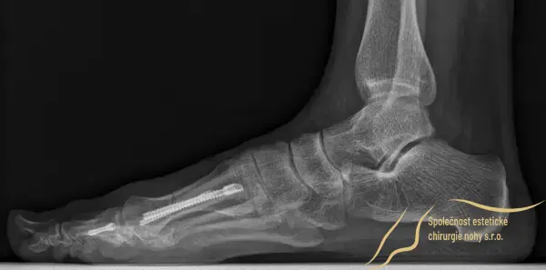 The bones of the big toe are secured in their new position with 3 screws