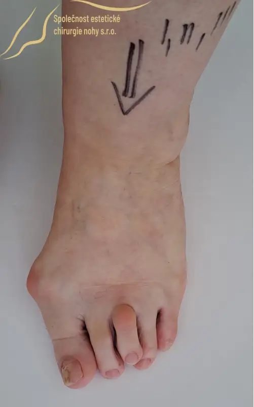 Bunion on right foot