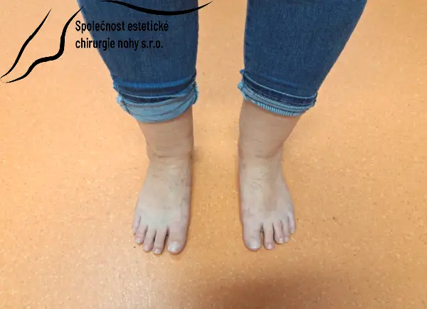 Postoperative image after mini-invasive correction of the deformity of the big toe and toes on the left foot and the big toe on the right foot
