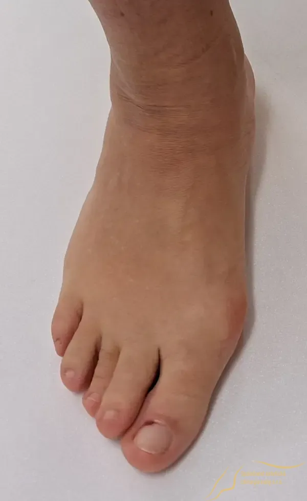 Preoperative photo of bunion