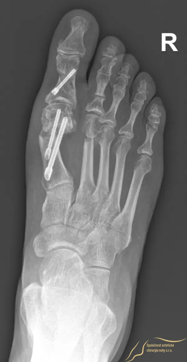 Postoperative X-ray