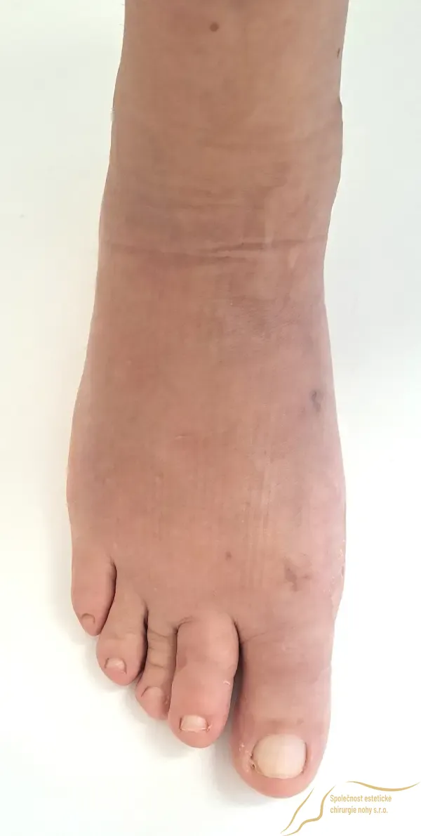 Forefoot 6 weeks after bunion surgery