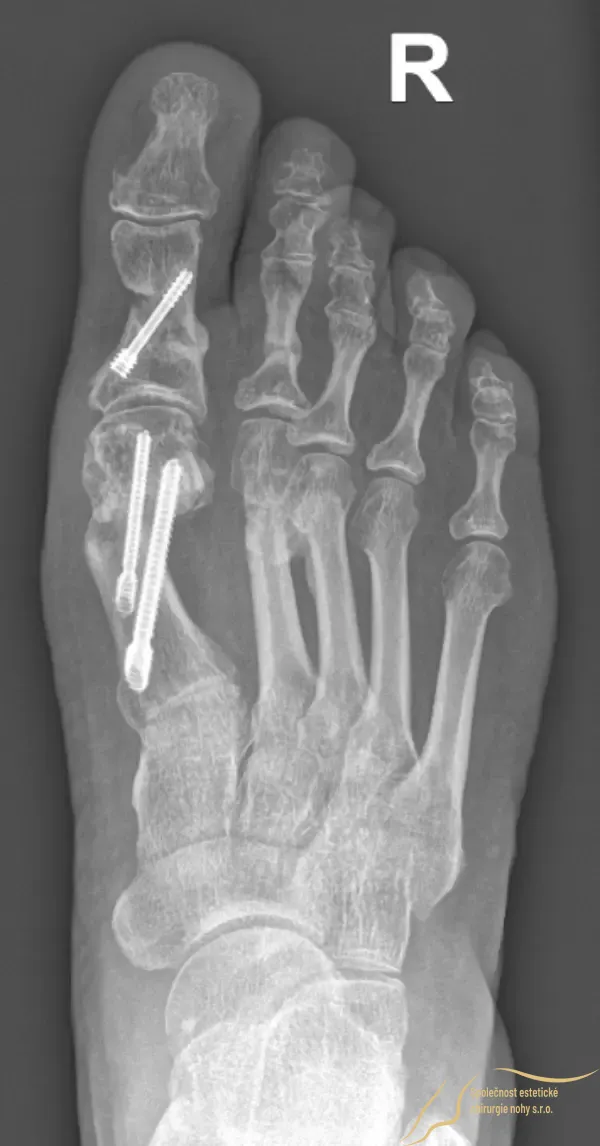 Postoperative X-ray of a bunion after the bones have healed